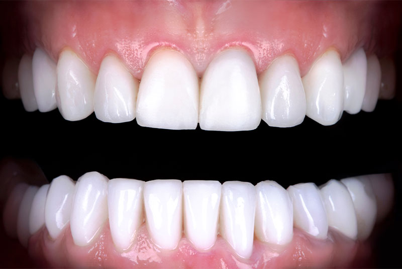 close up of before and after of dental procedure