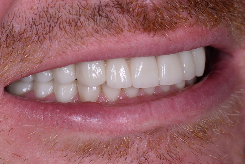 close up of before and after of dental procedure