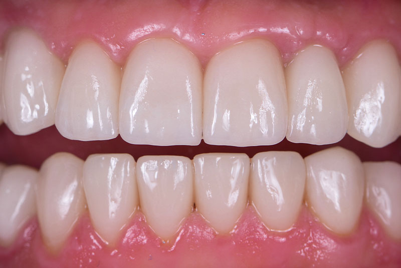 close up of before and after of dental procedure
