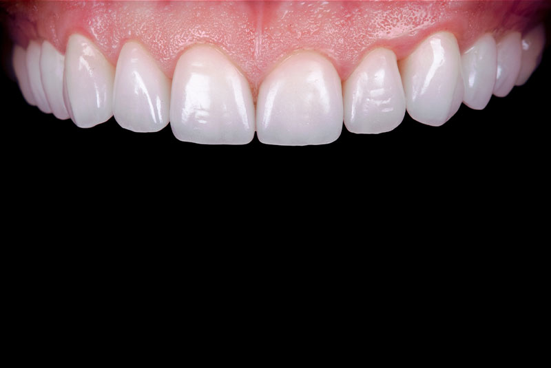 close up of before and after of dental procedure