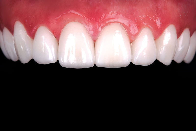 close up of before and after of dental procedure