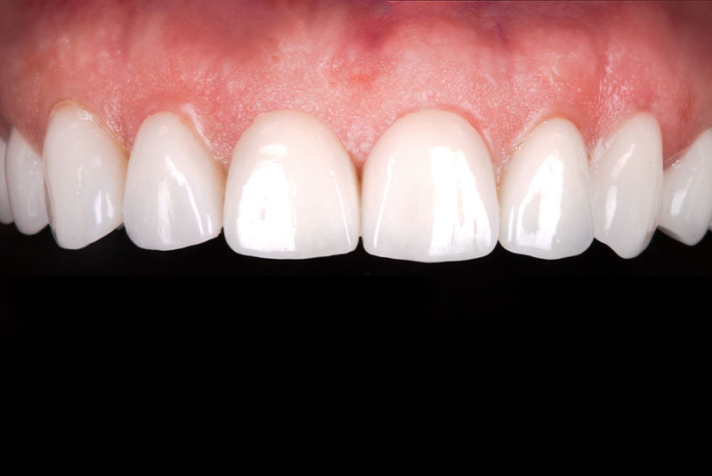 close up of before and after of dental procedure