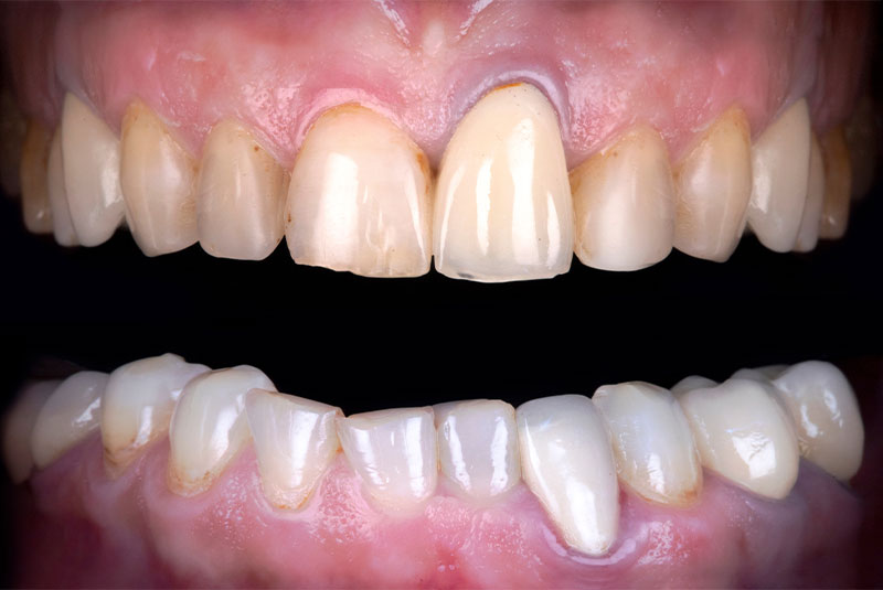 close up of before and after of dental procedure
