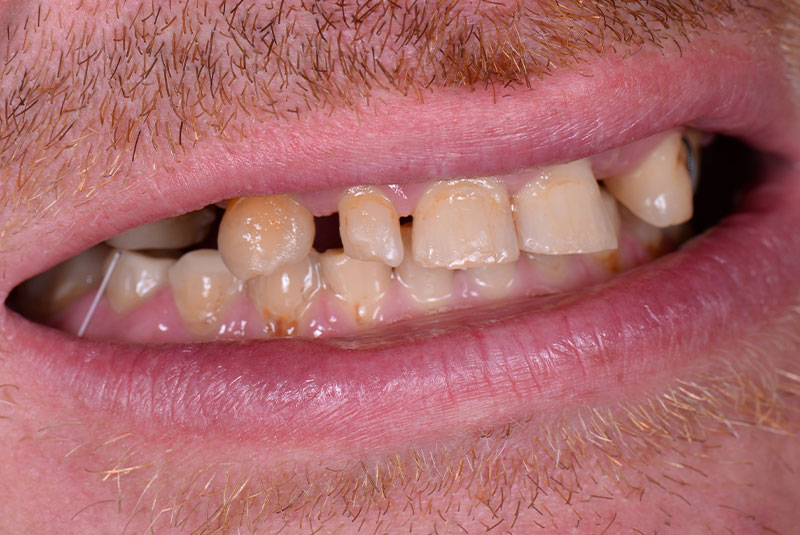 close up of before and after of dental procedure