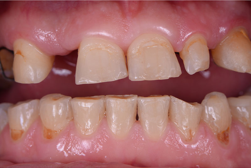 close up of before and after of dental procedure