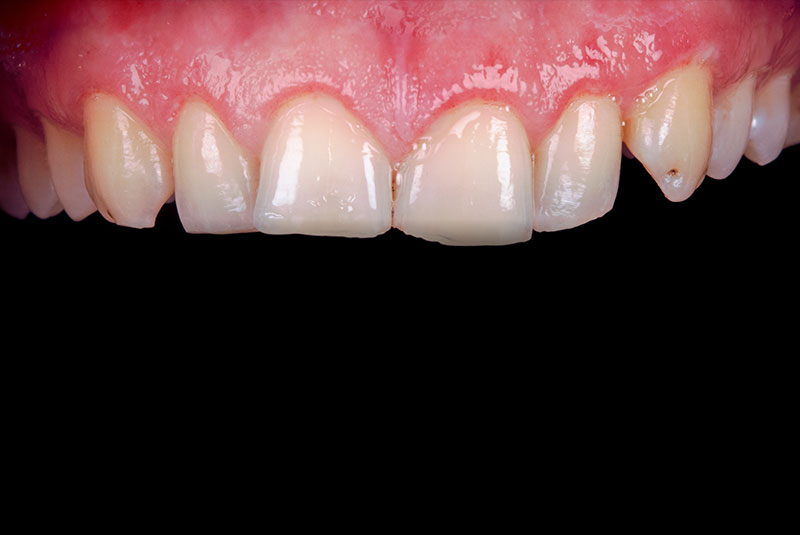 close up of before and after of dental procedure