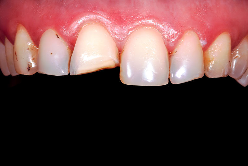 close up of before and after of dental procedure