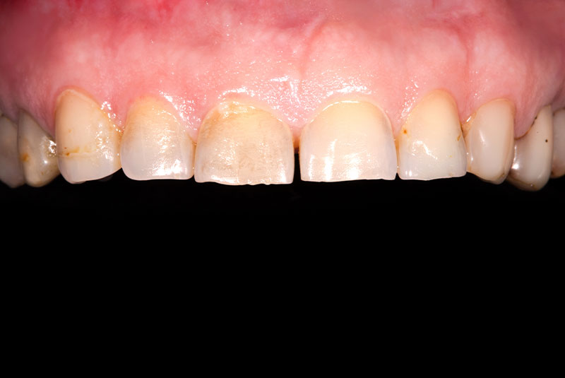 close up of before and after of dental procedure