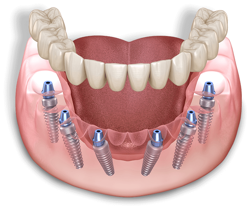 full arch dental implant illustration