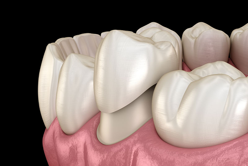Dental crown premolar tooth assembly process. Medically accurate 3D illustration of human teeth treatment
